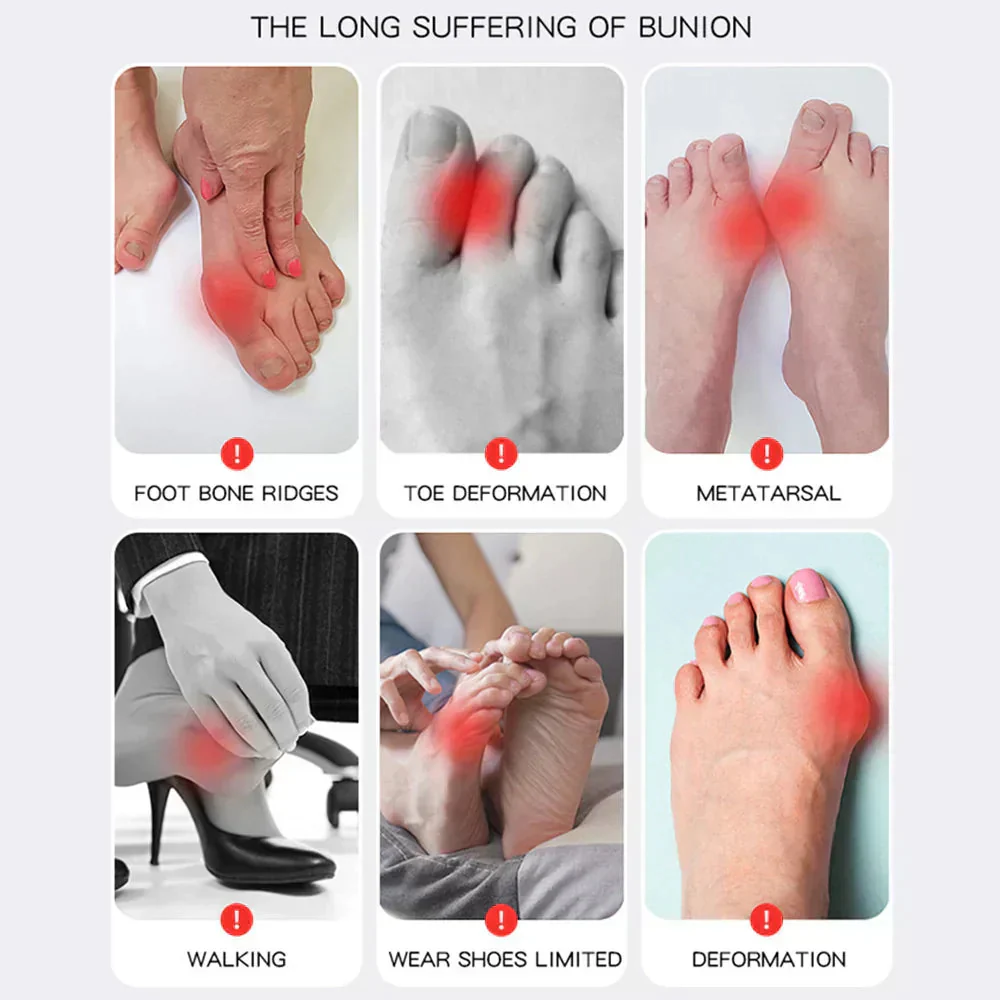 OrthoFlex – Pain-Free Steps for Hallux Valgus! - Image 5